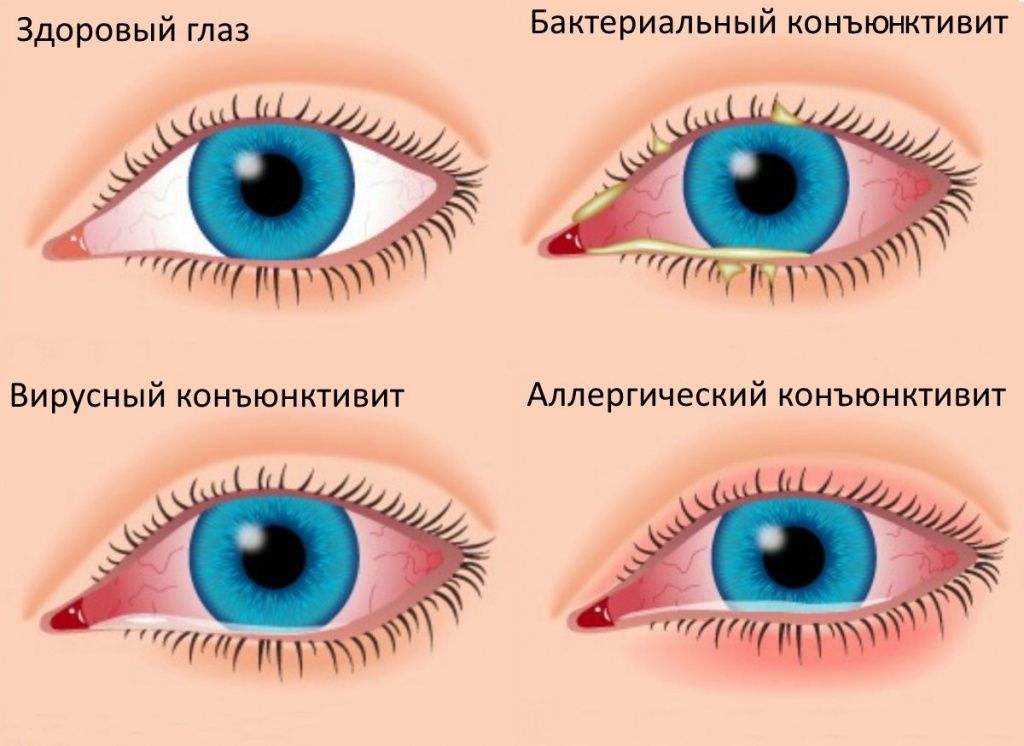 конъюктивит глаз - виды конъюктивит глаз