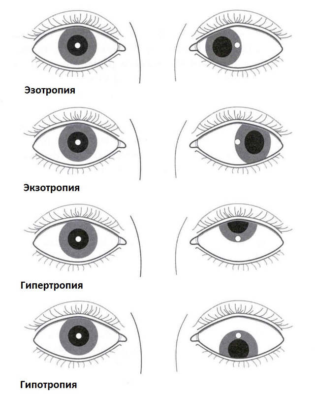 виды косоглазия косоглазие